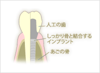 インプラント