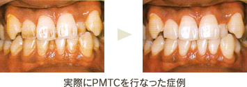 実際にPMTCを行なった症例